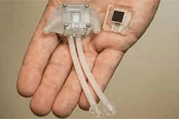 Artificial Kidney Could Eliminate Need For Kidney Dialysis